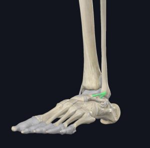 Anatomical image of an ankle highlighting the ATFL